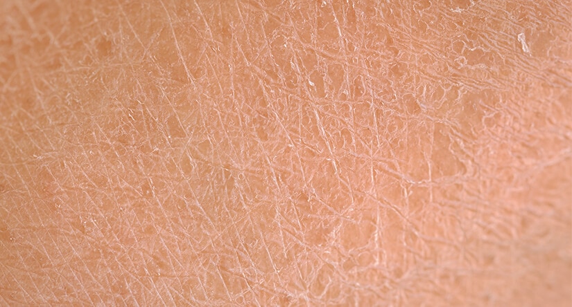 Cómo cuidar de la piel seca: causas, tratamiento y prevención