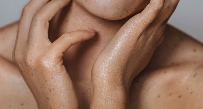 Cómo cuidar de la piel con tendencia a sufrir eccema: síntomas, causas, tratamiento y prevención Cómo cuidar de la piel con tendencia a sufrir eccema: síntomas, causas, tratamiento y prevención