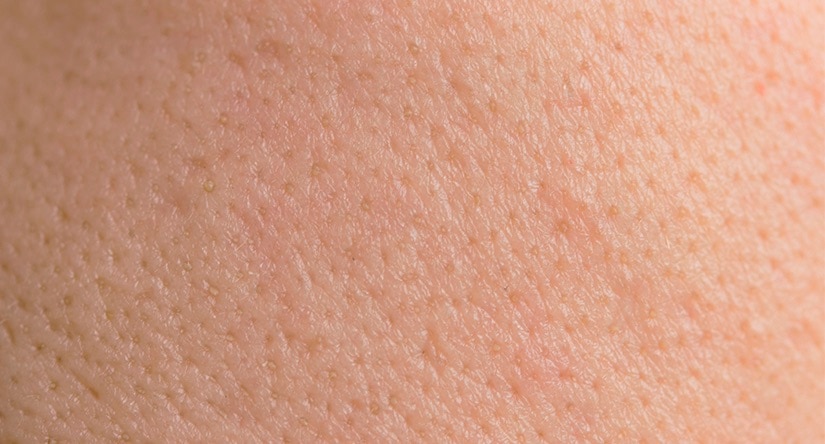 Cómo cuidar de la piel grasa: causas, tratamiento y prevención