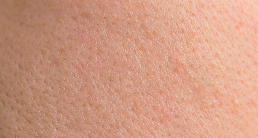 Cómo cuidar de la piel grasa: causas, tratamiento y prevención Cómo cuidar de la piel grasa: causas, tratamiento y prevención